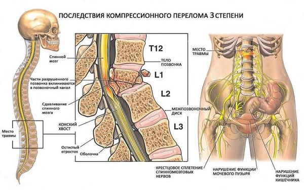 Осложнения компрессионного перелома позвоночника