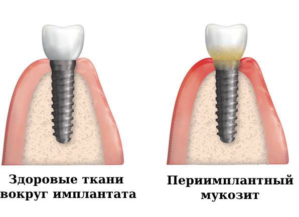 Норма и периимплантный мукозит