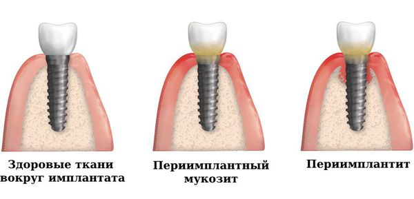 Мукозит и периимплантит