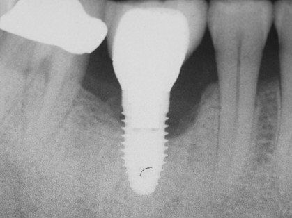 Периимплантит на рентгенограмме 