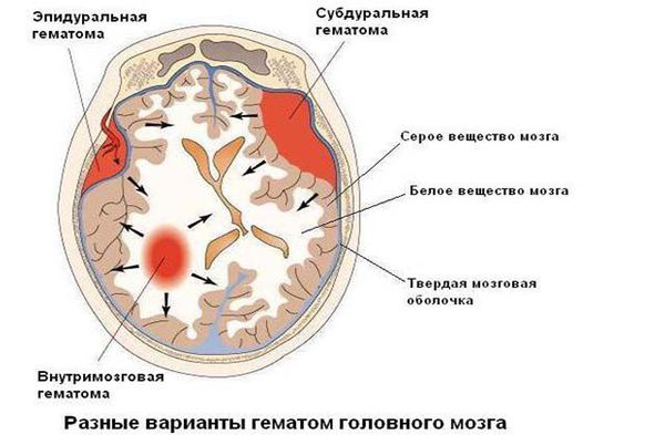 Гематомы головного мозга