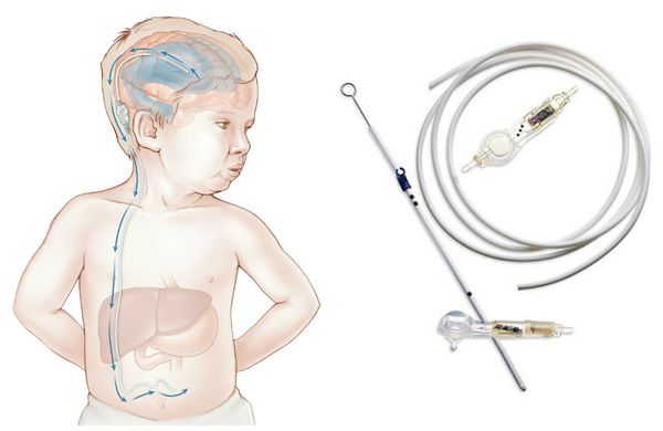 Шунтирование головного мозга