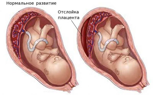 Отслойка плаценты