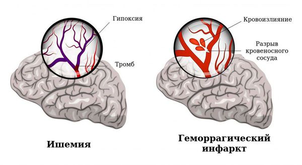 Геморрагический инфаркт и ишемия