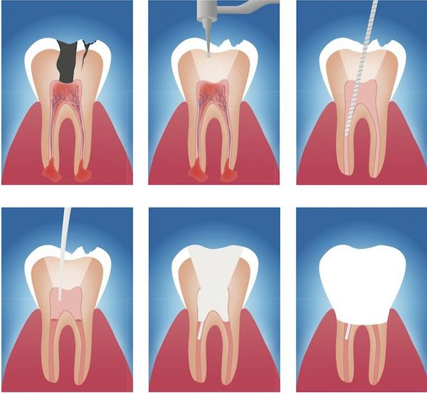 Этапы эндодонтического лечения