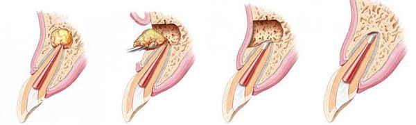 Удаление части корня зуба (резекция)