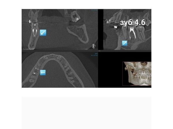 Зуб 4.6 на снимке КТ после лечения