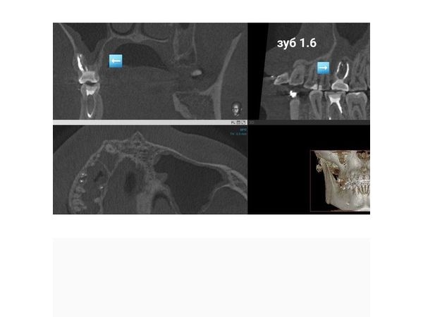 Зуб 1.6 на снимке КТ после лечения