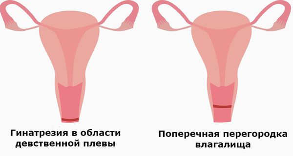 Гинатрезия девственной плевы и поперечная перегородка влагалища