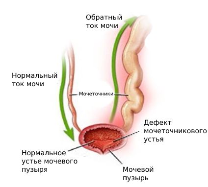 Пузырно-мочеточниковый рефлюкс