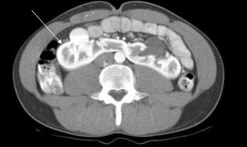 Компьютерная томограмма с подковообразной почкой 