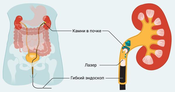 Ретроградная пиелолитотрипсия