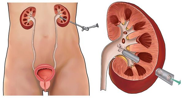Чрескожная нефролитотрипсия
