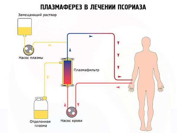 Плазмаферез в лечении псориаза