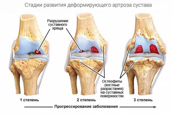 Остеоартроз суставов