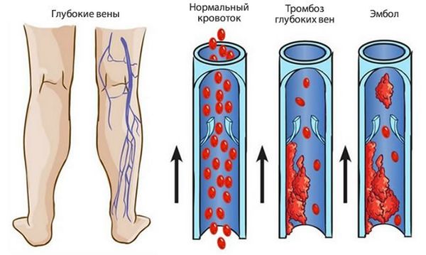 Тромбоз в венах ног