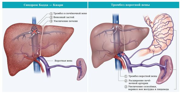 Синдром Бадда — Киари и тромбоз воротной вены 