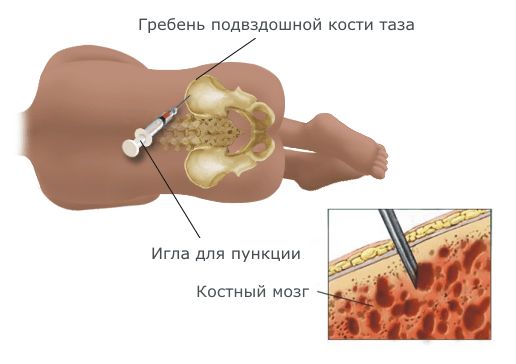 Трепанобиопсия костного мозга