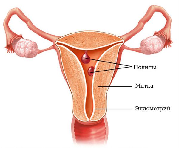 Полип тела матки