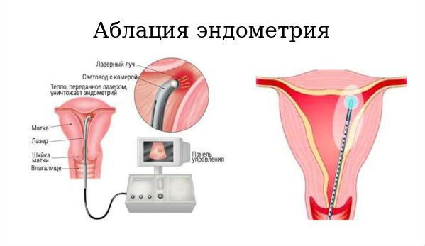 Аблация эндометрия