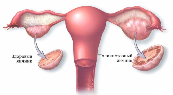 Синдром поликистозных яичников