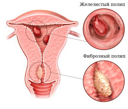 Типы полипов эндометрия