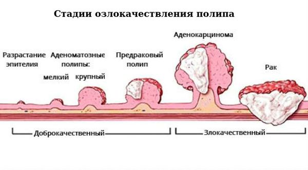 Стадии озлокачествления полипа