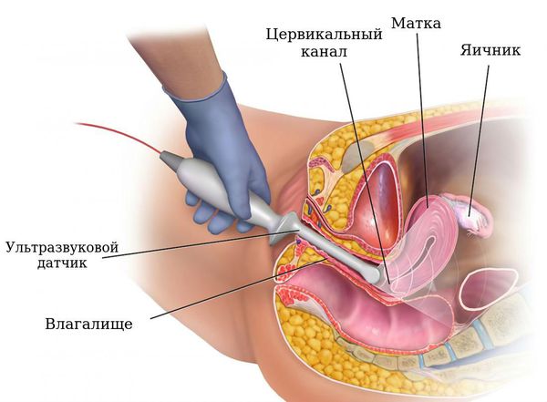 Трансвагинальное ультразвуковое исследование