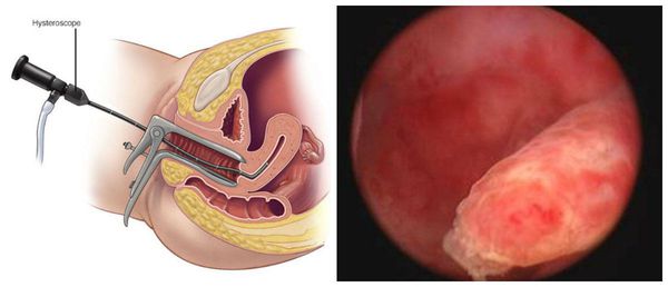 Гистероскопия. Полип эндометрия.