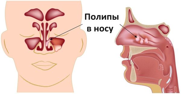 Полипоз носа