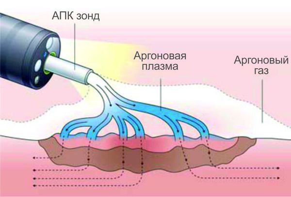 Механизм воздействия аргоноплазменного коагуляторя