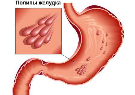 Полипы желудка