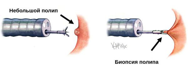 Биопсия полипа