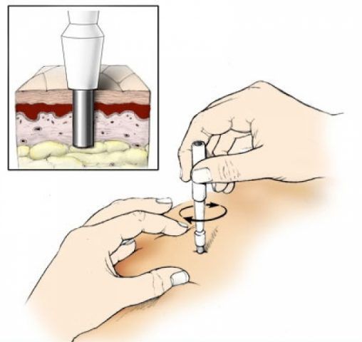 Кожная пункционная биопсия