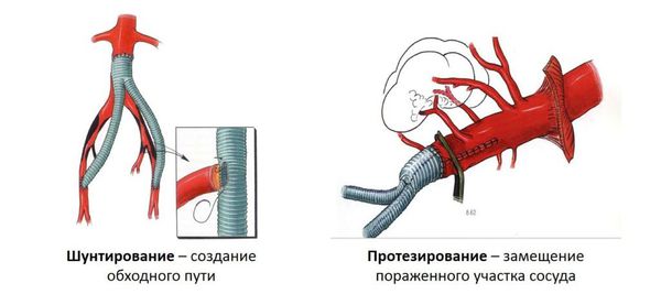 Шунтирование и протезирование