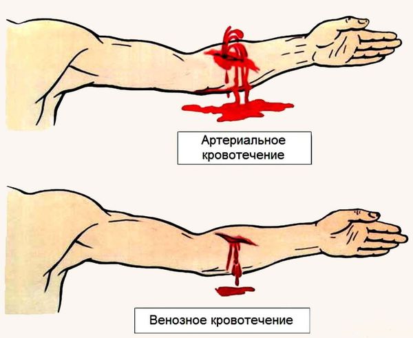 Артериальное и венозное кровотечение