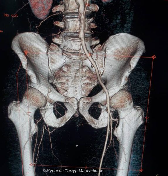 На КТ нет кровотока по общей подвздошной артерии справа