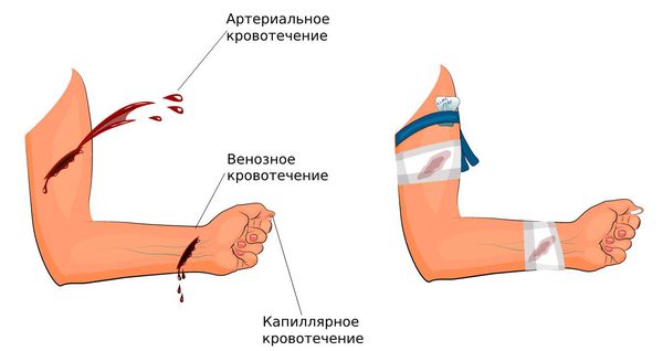 Остановка разных типов кровотечения