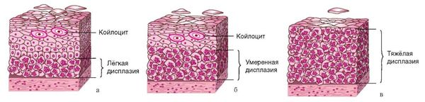 Степени дисплазии