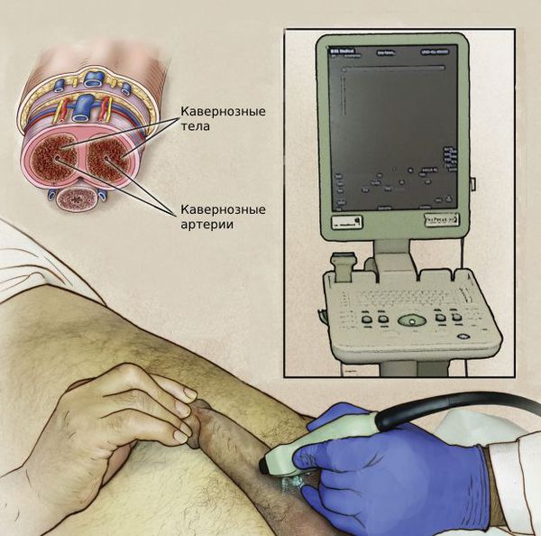 Ультразвуковое исследование полового члена