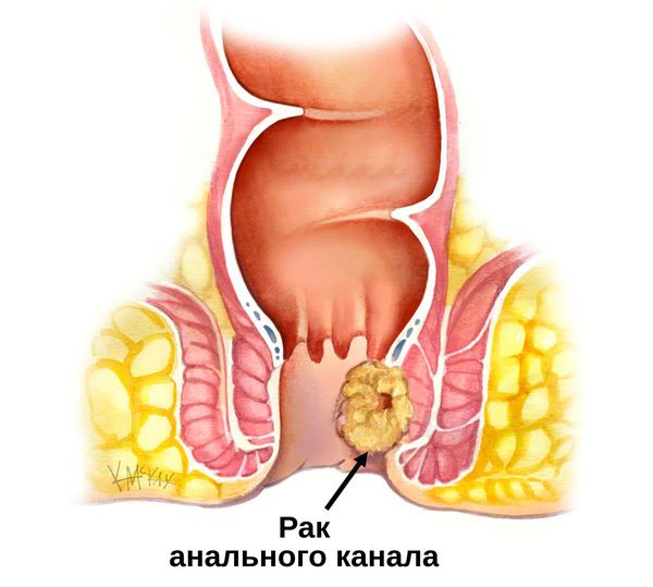 Опухоль анального канала