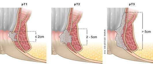 Стадии рака анального канал (размеры опухоли)
