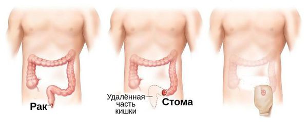 Брюшно-промежностная экстирпация