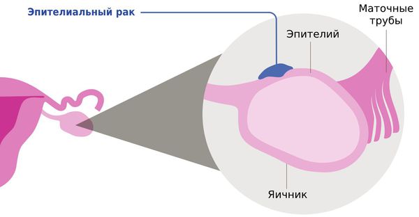 Эпителиальный рак яичника