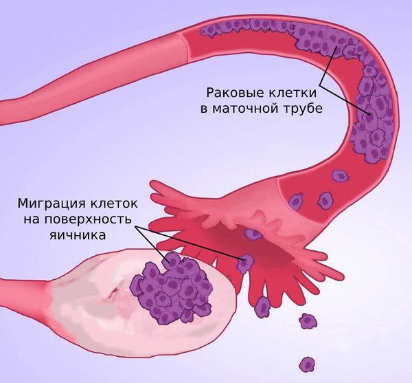 Миграция раковых клеток из маточной трубы на эпителий яичника