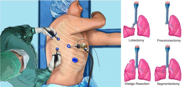 Хирургический метод лечения рака лёгкого