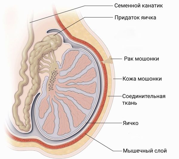 Рак мошонки