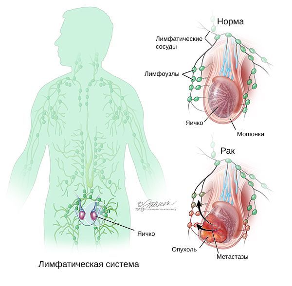 Метастазы рака яичка и мошонки