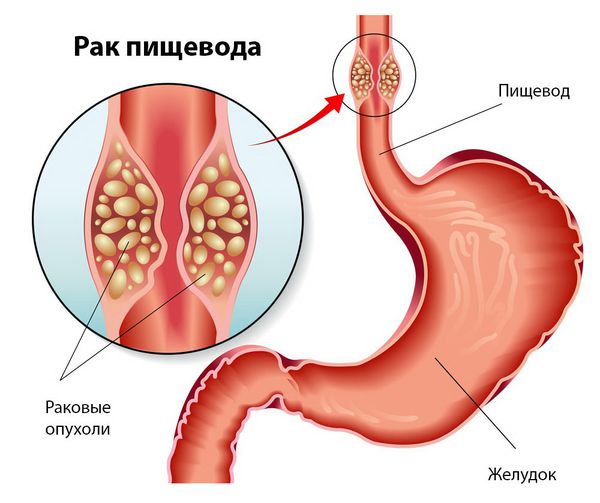 Рак пищевода