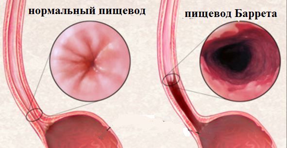 Пищевод Баррета